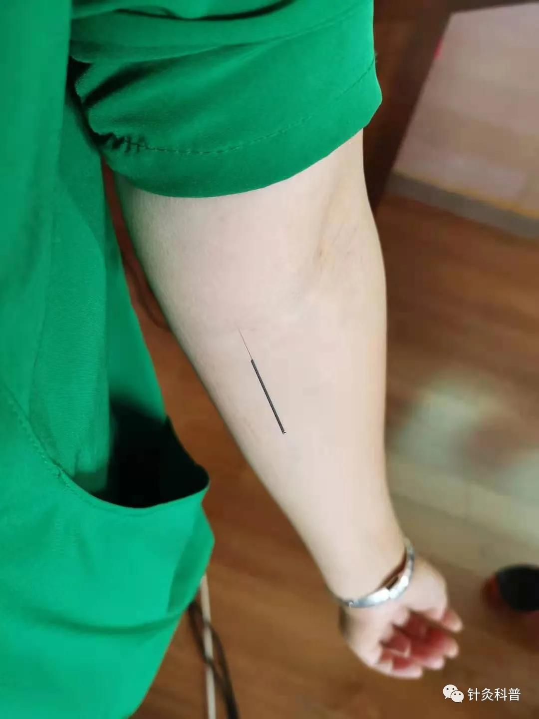 针灸治疗常见疾病方法,伤寒杂病论和针灸