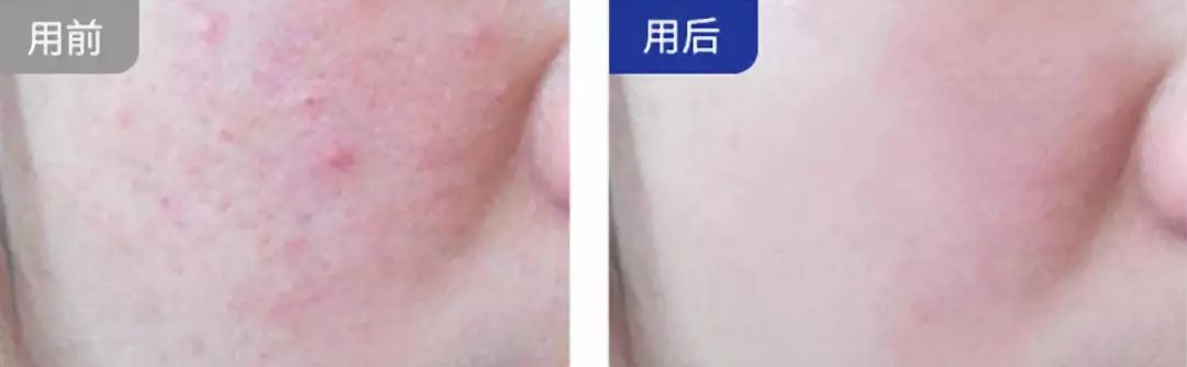 李湘直播间推荐祛痘,李湘推荐美容仪小v脸