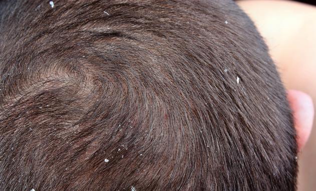 儿童有头皮屑是缺少维生素吗,头皮屑多缺维生素b2和b6