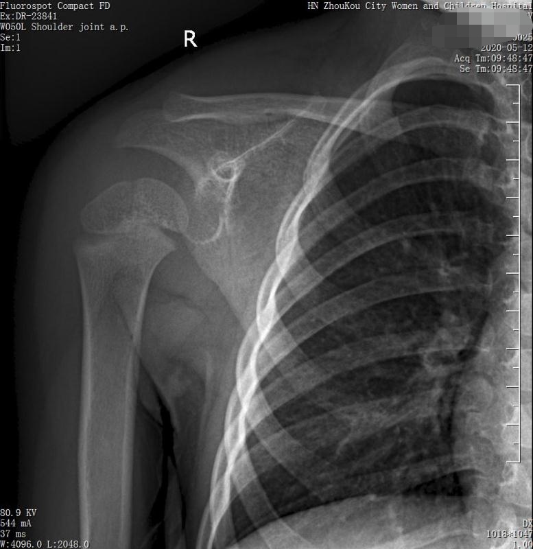 家长要警惕孩子腺样体面容,家长应该警惕孩子出现异常