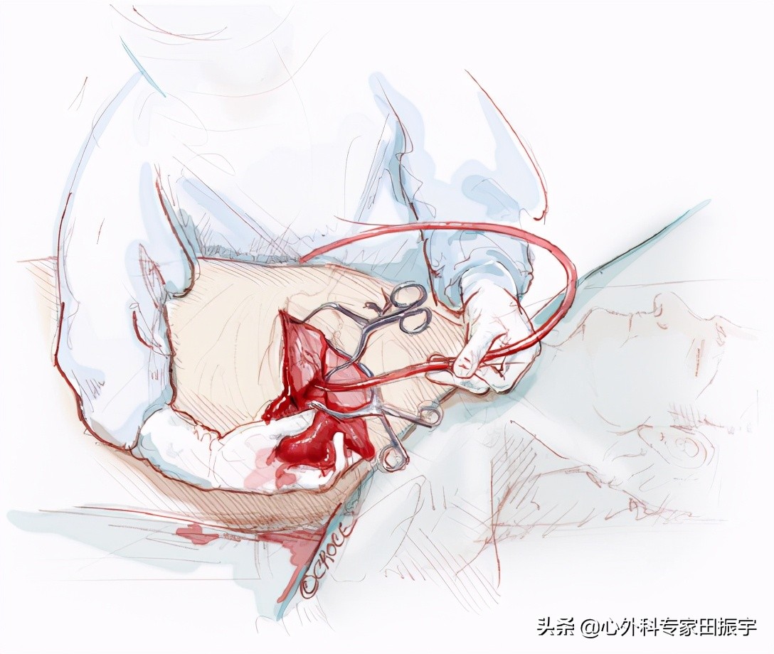 主动脉夹层破裂b型,急性主动脉夹层动脉瘤破裂