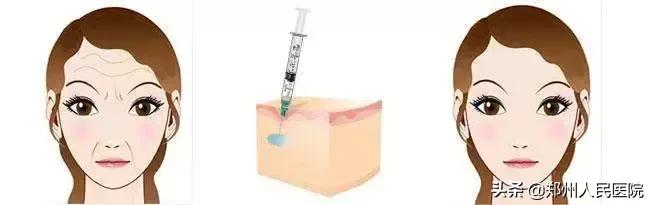别急！注射玻尿酸之前，先弄清楚这几件事儿