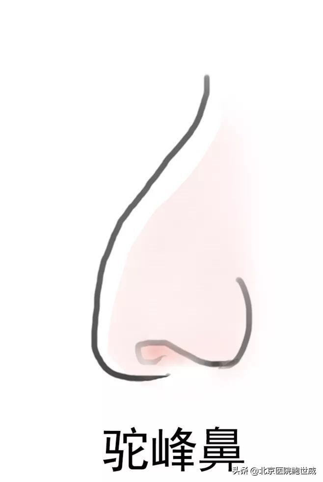 天生鼻型不完美怎么办呢,八种鼻型不佳图片