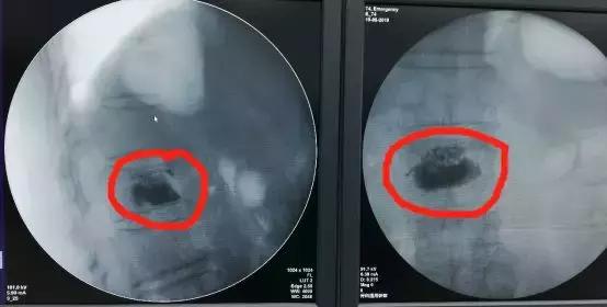腰椎骨折一个月后可以下地走吗,腰椎横突骨折多久可以下床大小便