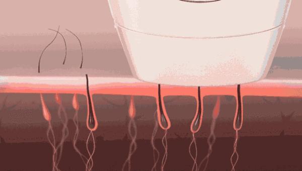 脱毛激光,脱毛各种方式比较