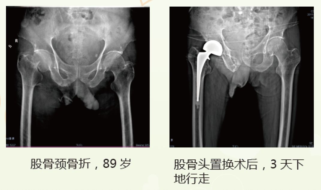 老人髋部骨折多长时间恢复到正常,老年人骨折无法固定怎么办