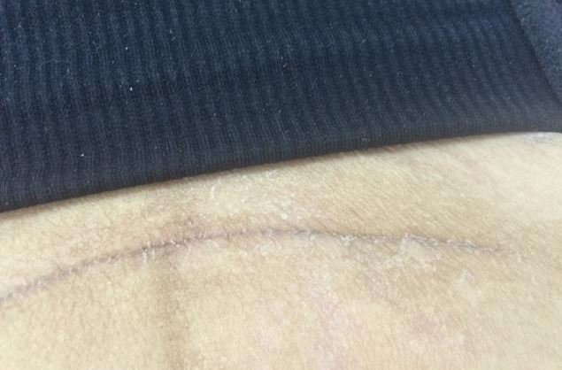 剖腹产妈妈怎么调理身体,剖腹产宝妈伤口护理正确的方法