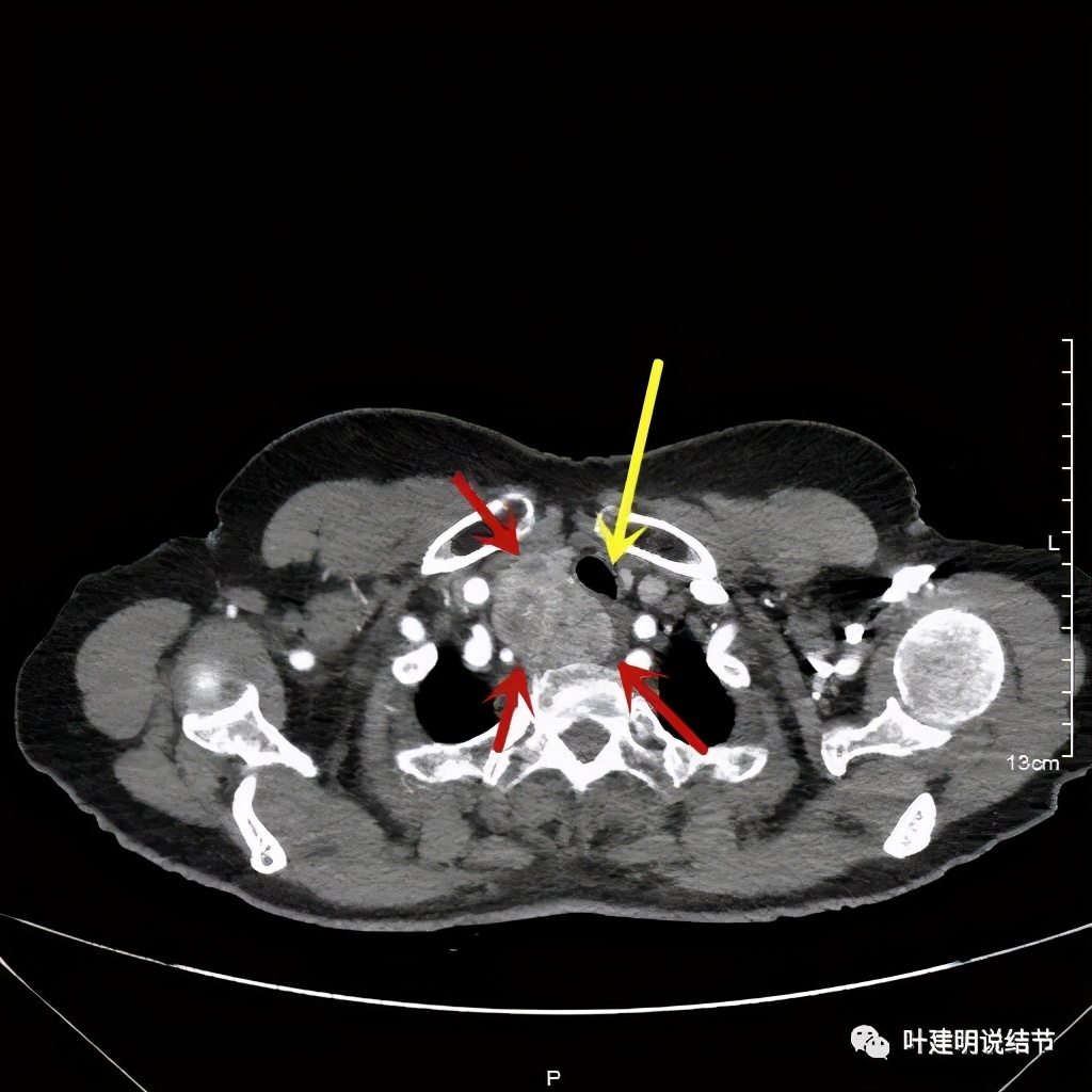 胸部高分辨ct检查注意事项,胸部ct扫描有没有危害