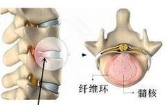 腰椎膨出和突出还有脱出图片,腰椎间盘突出脱出膨出区别