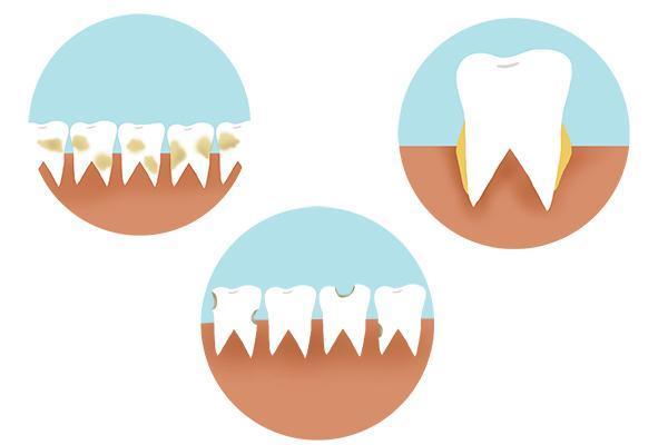 牙缝抠出来的硬物是什么,牙缝有小石子怎么去除