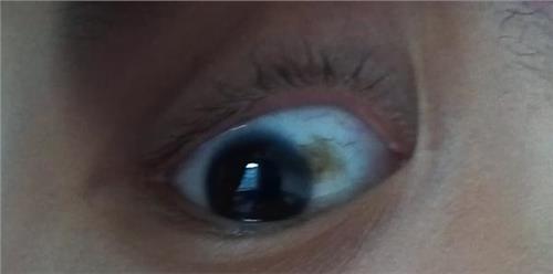 人的眼睛为什么有黑眼球和白眼球,白眼球和黑眼球交界处有个疙瘩