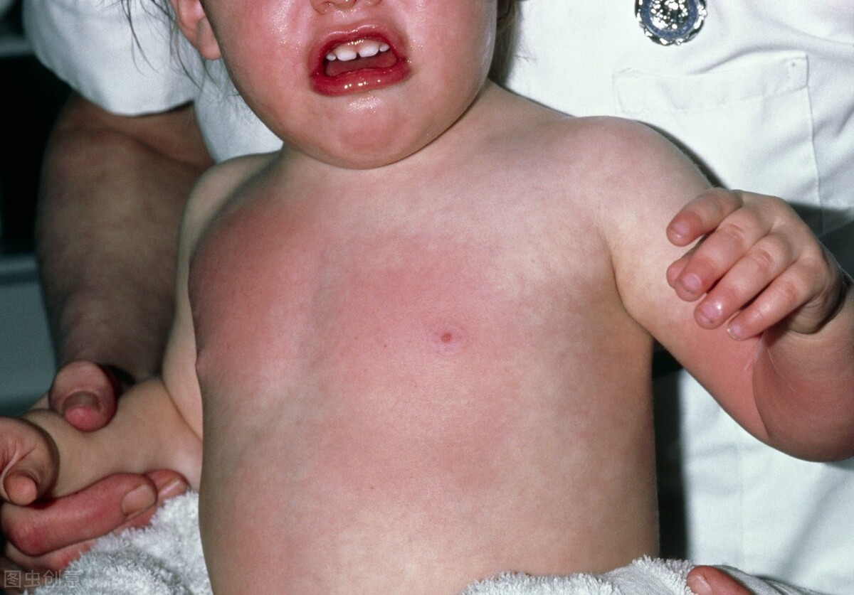 儿童烫伤怎么治疗最有效,烫伤处理办法给孩子看