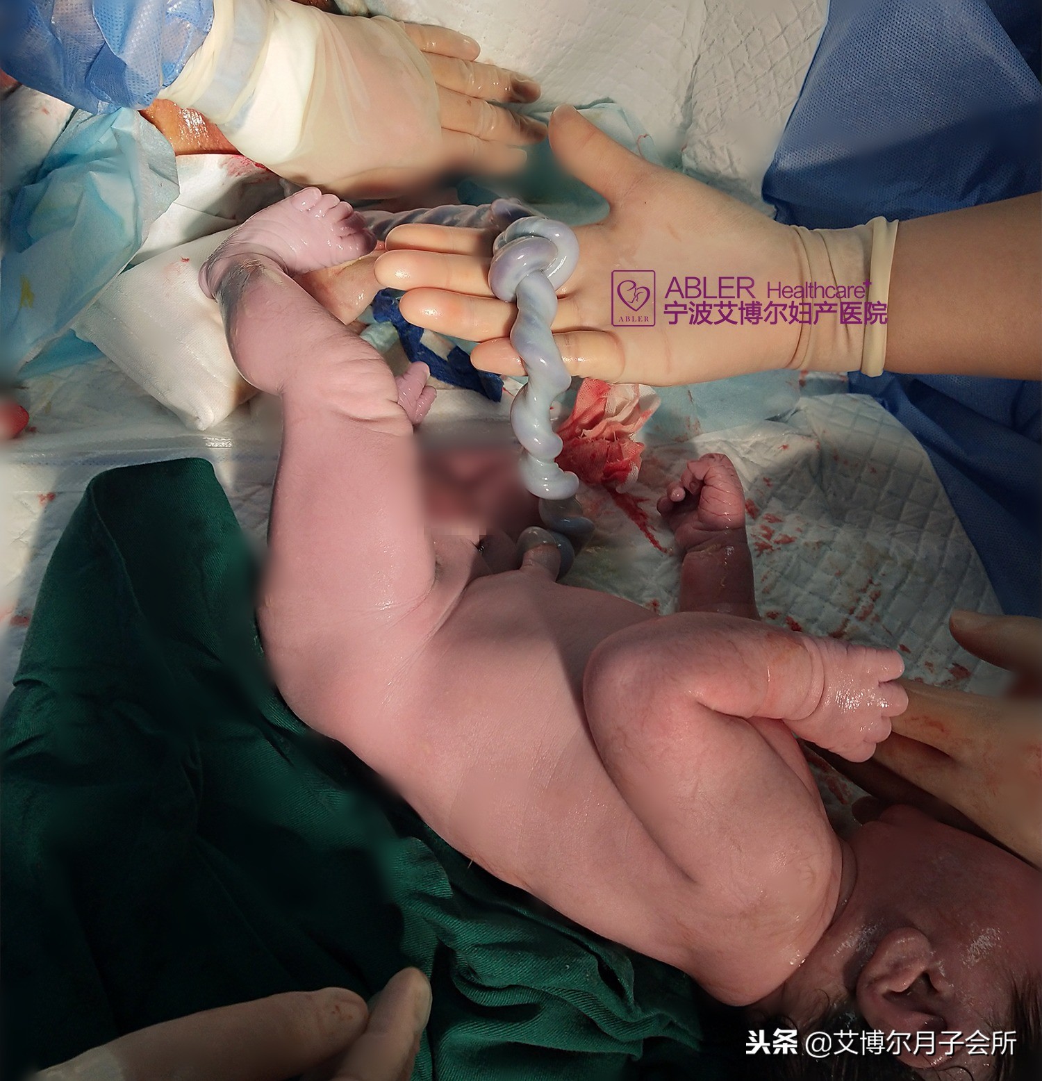 宁波胎儿“过于活泼”脐带打真结,医生都捏一把汗