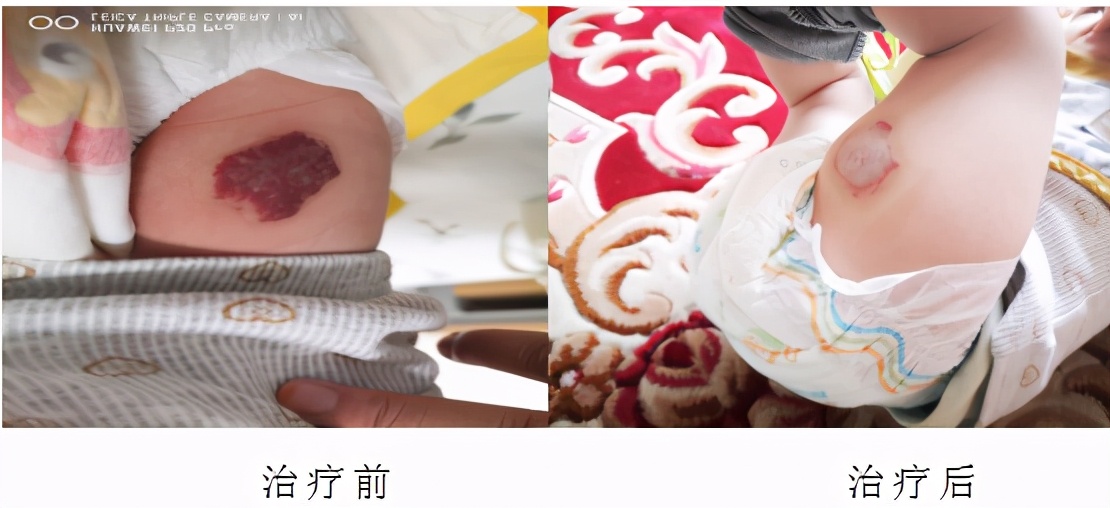 锶敷贴治疗血管瘤,90锶敷贴治疗血管瘤费用