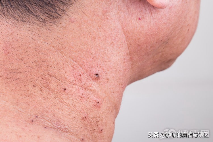 什么样的痣是皮肤癌的前兆,后期长出来的痣一定是皮肤癌吗