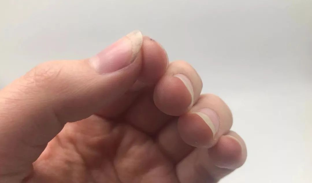 娃指甲上有白点是怎么回事,孩子指甲横纹有白点
