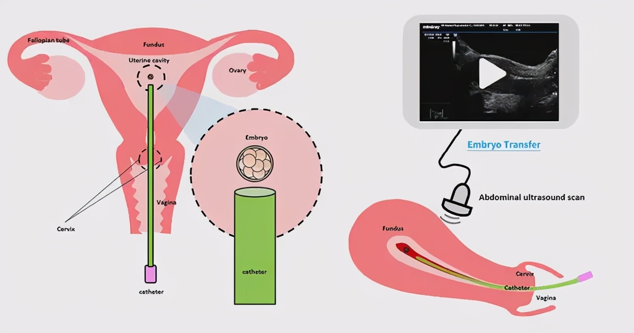 试管移植14天绒毛激素2.3,试管移植前打生长激素有什么作用