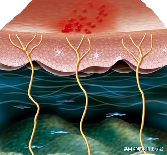 缠腰龙神经痛去医院挂什么科,缠腰龙疼得受不了怎么办