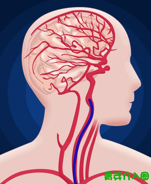 颅内动脉瘤介入栓塞支架全过程,颅内夹层动脉瘤介入演示