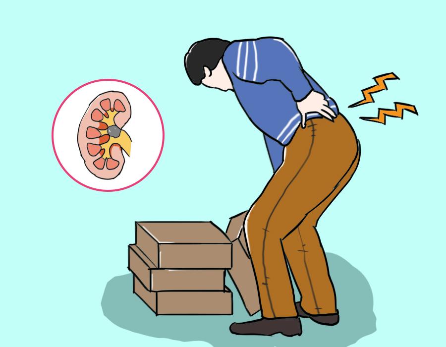 43岁男子腰痛以为肾结石,男子腰部隐隐作痛一查竟是肾结石