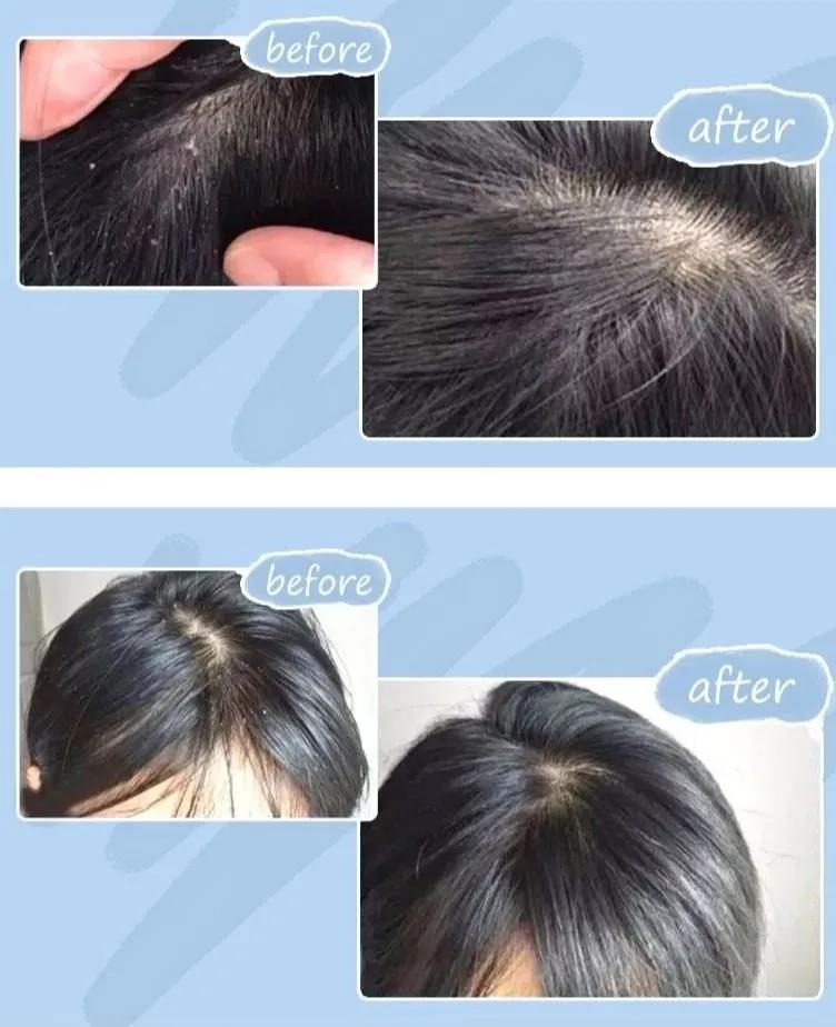 天天散着头发容易脱发吗,头发油了特别容易脱发