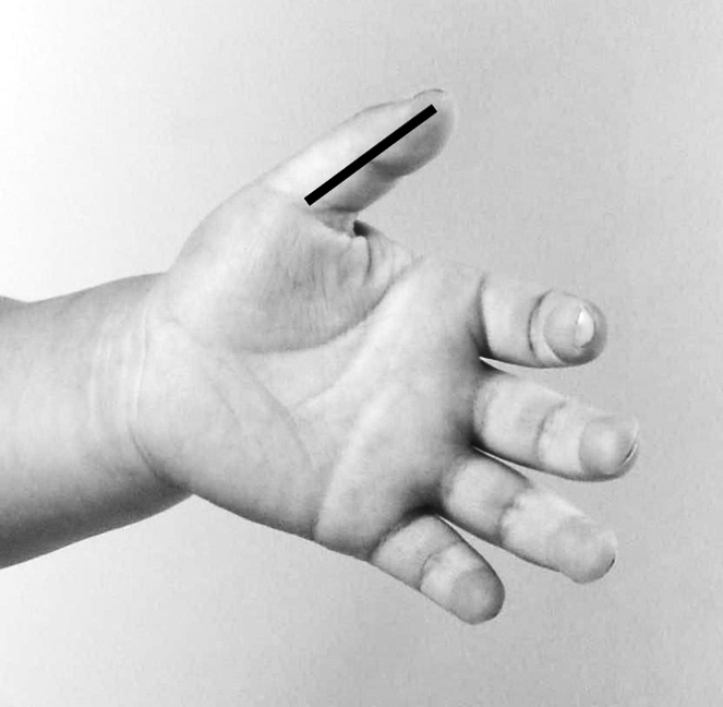 过敏性鼻炎推拿有效果吗,小宝宝过敏性鼻炎怎么推拿