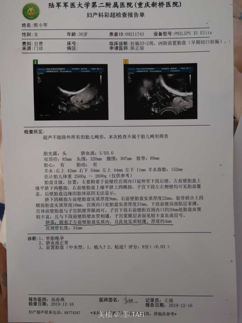切口妊娠的治疗方法,切口妊娠人流危险吗