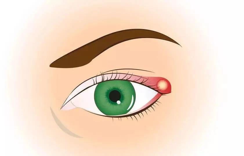 眼睛肿包警惕麦粒肿，麦粒肿是什么？吃什么帮助缓解？