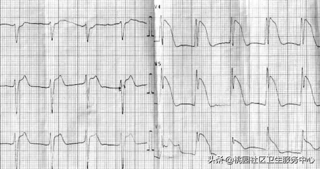 早期心梗心电图能查出来吗,警惕这种要命的心电图表现