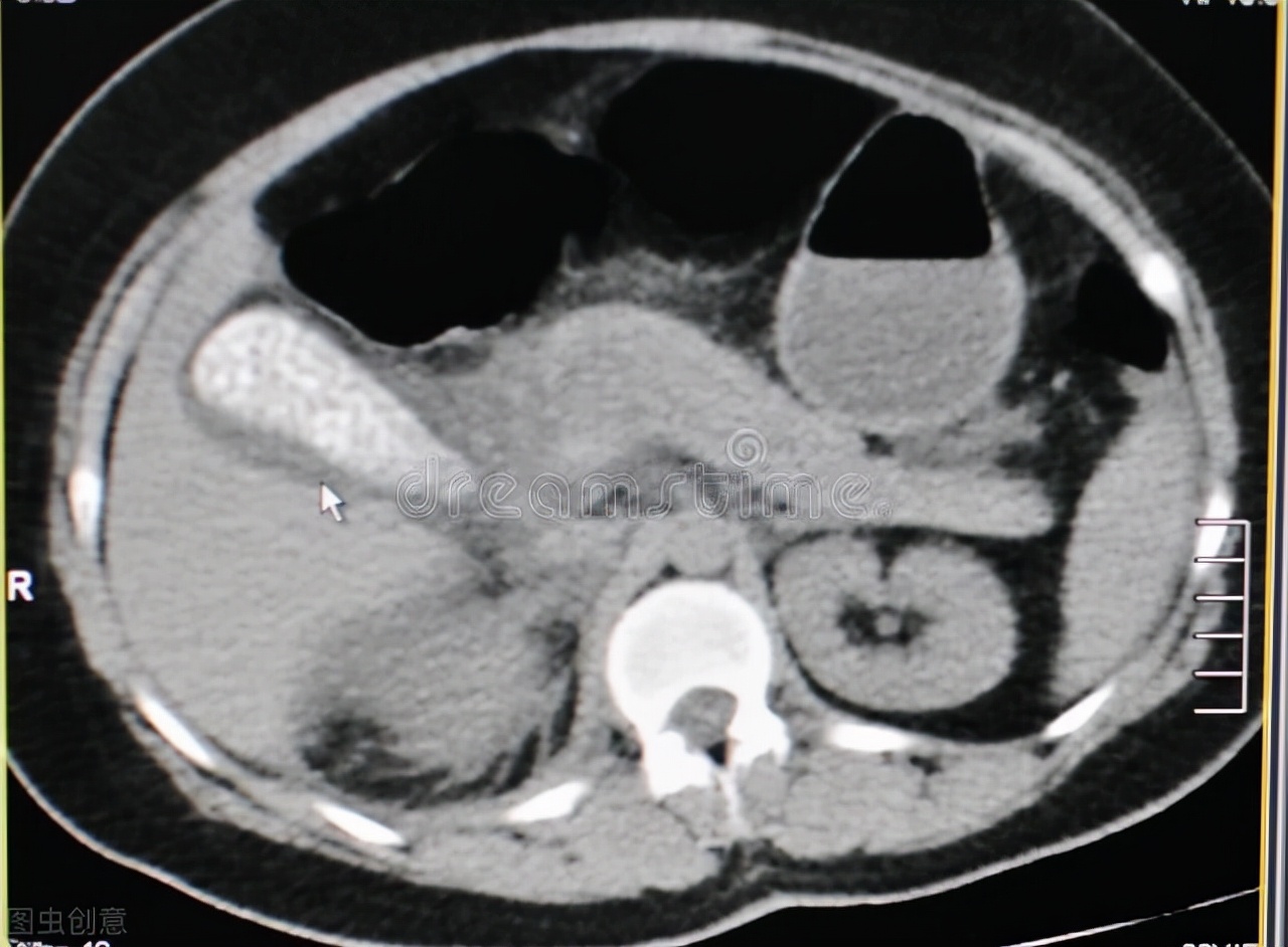 55岁女子受不明原因腹痛20年,50岁女人腹部有点隐痛持续很多天