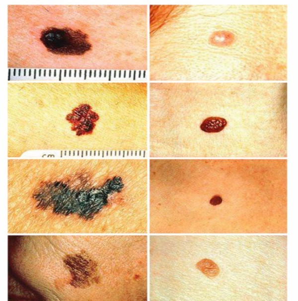 色素痣会变成白癜风吗,右眼脉络膜色素痣是黑色素瘤吗