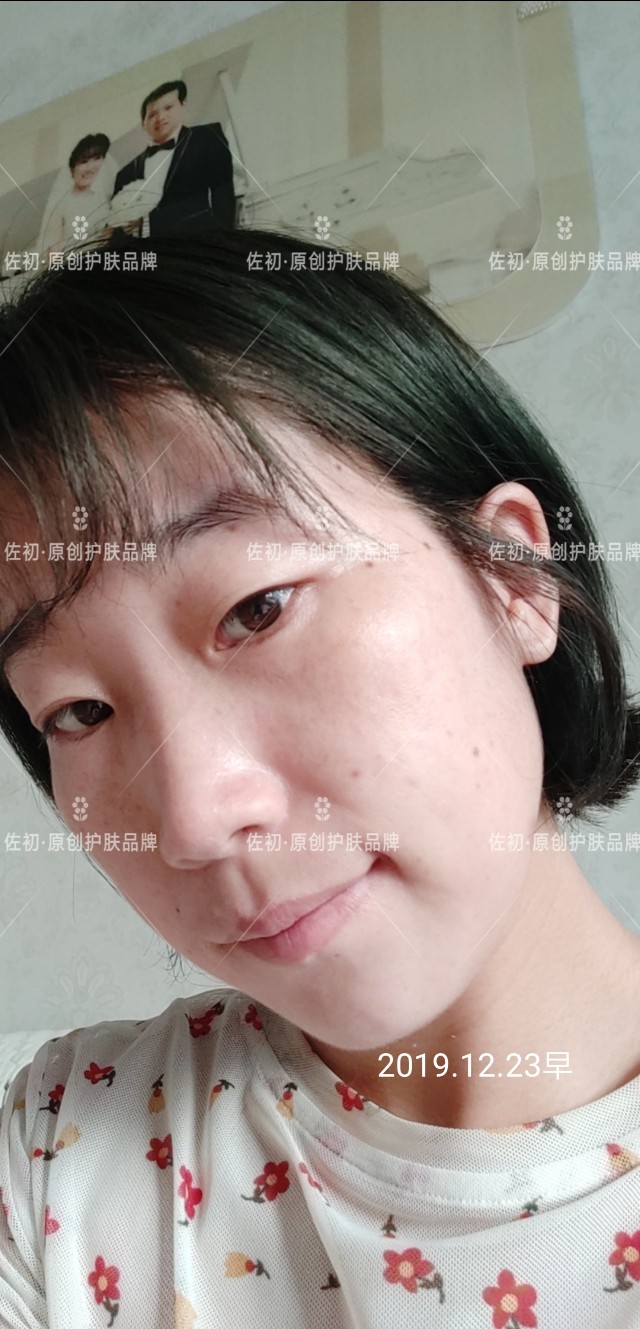 生完孩子烂脸,生完孩子脸上垮了怎样处理