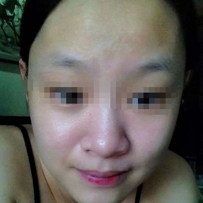 热带小黑虫怎么预防叮咬,弥勒小黑虫叮了起水泡