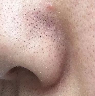 男生如何瘦腿,男生去黑头最好的面膜