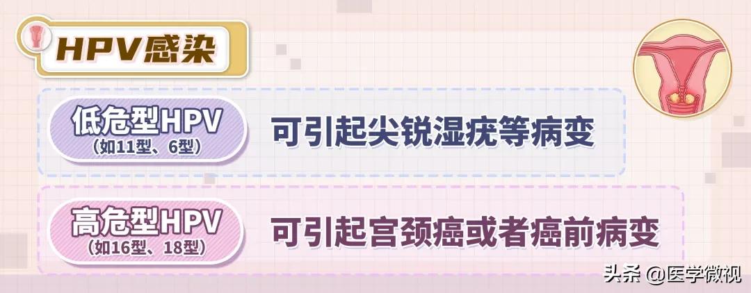 宫颈癌tct检查结果显示有轻度炎症,宫颈癌tct报告单可见挖空细胞