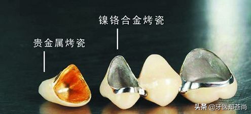 烤瓷牙哪个材料好,后牙到底用什么烤瓷牙材料合适呢