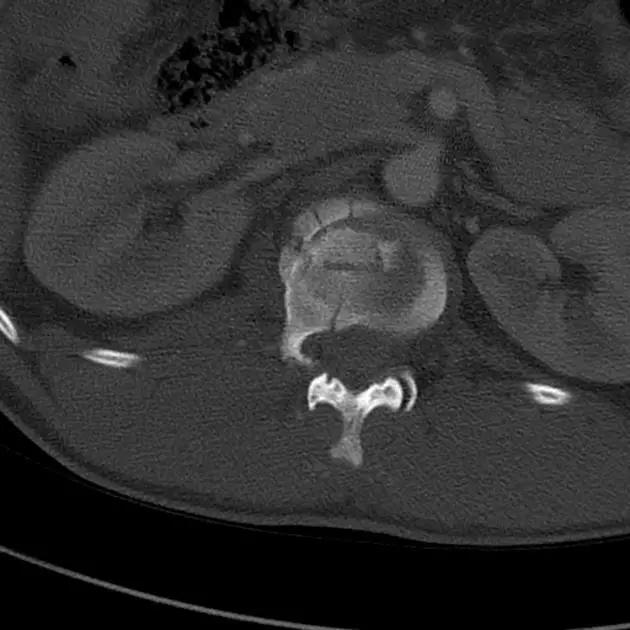 所有骨折都叫什么名字,骨折的名称有哪些