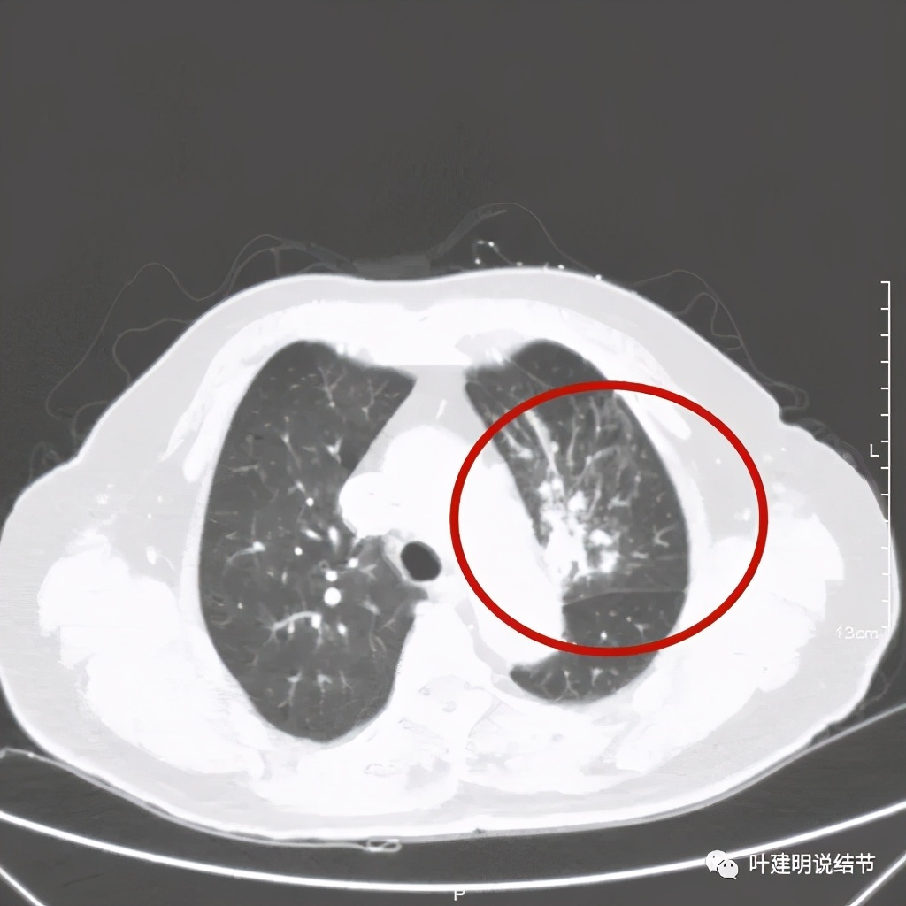 卡瑞利珠单抗治疗肺鳞癌有用吗,特瑞普利单抗对鳞癌治疗有效吗
