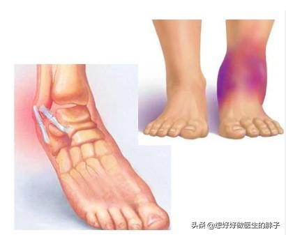 您重视过踝关节扭伤吗?扭伤3个月还不好,我们应该做点什么呢?