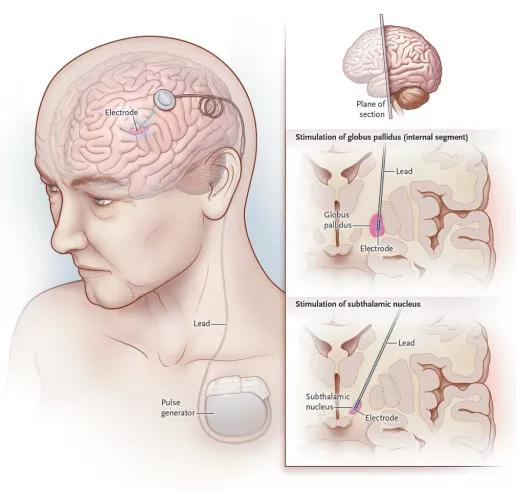 帕金森手部康复治疗,帕金森病能否被完全治愈医学科普