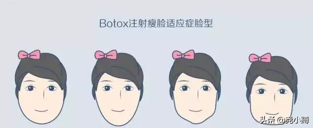 瘦脸针的科普,瘦脸针知识普及