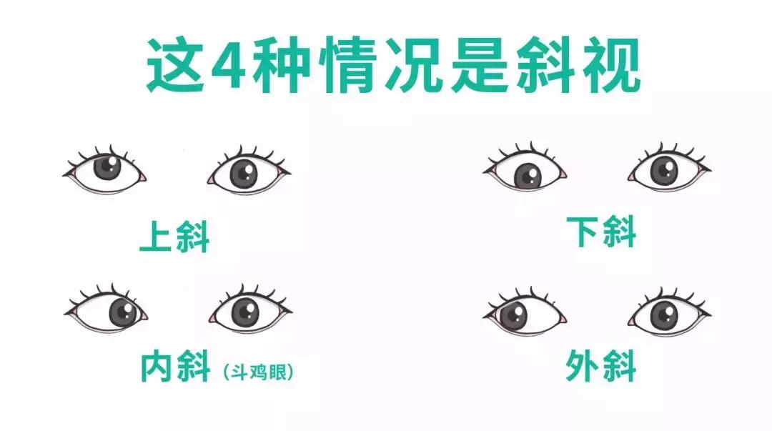 3秒辨别孩子是不是斗鸡眼,怎么判断小孩斗鸡眼