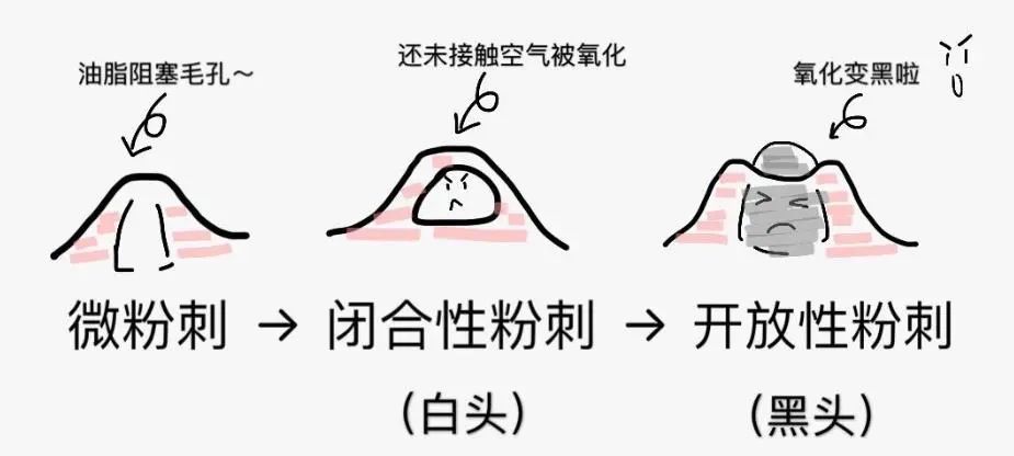 黑头多怎么办如何去除黑头,黑头贴去除顽固黑头