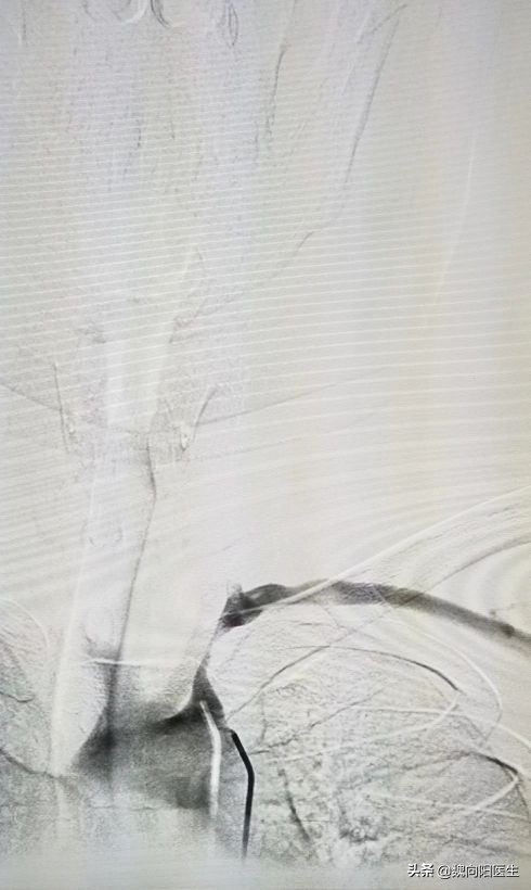 血压左高右正常是高血压吗,两侧血压值相差40有什么危险吗