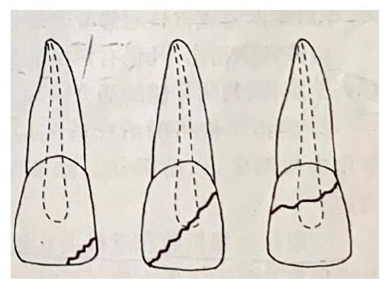 牙齿松动多久恢复好,折断的牙齿怎么治疗