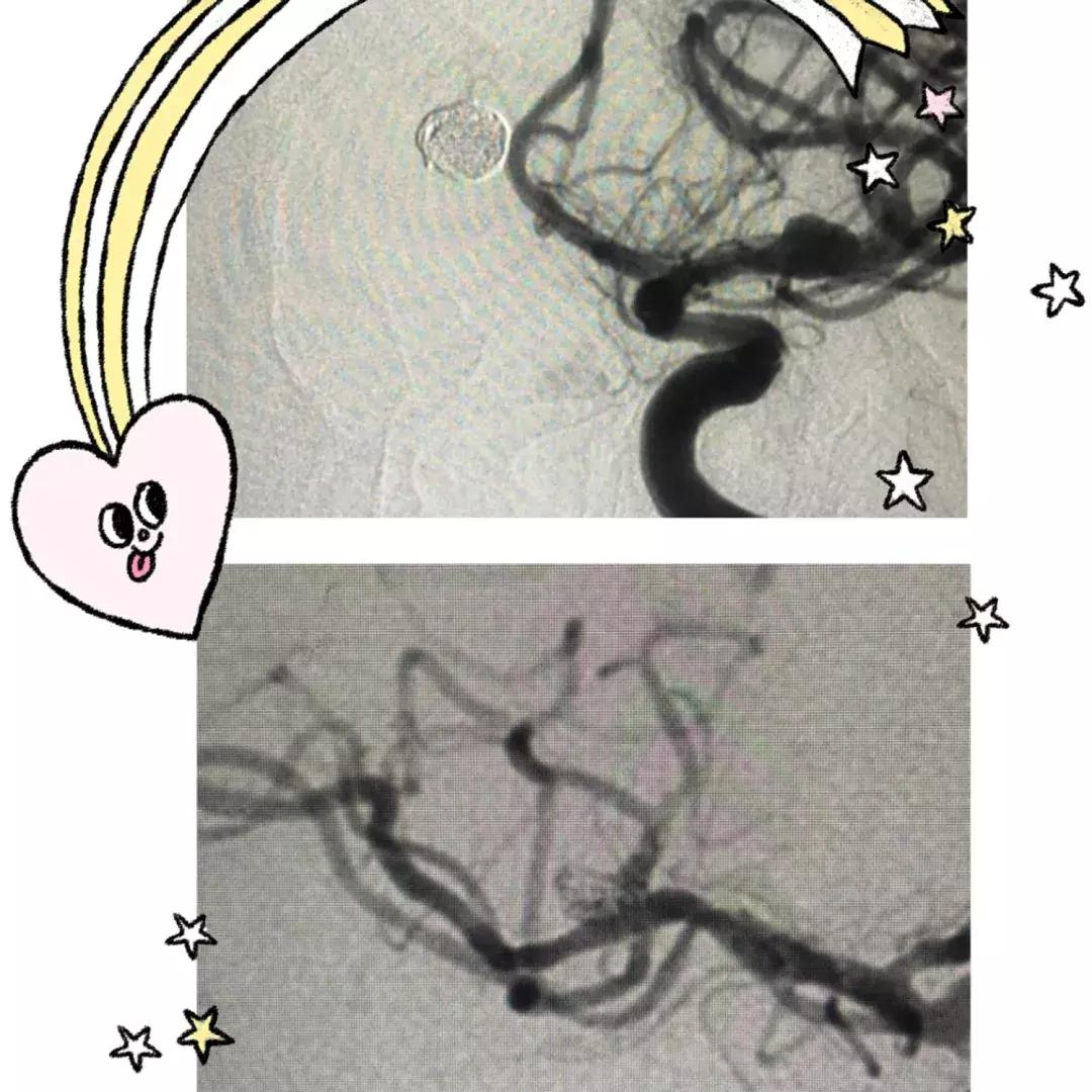 动脉瘤弹簧圈栓塞术护理问题,介入脑动脉瘤填塞弹簧圈