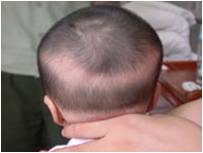 宝宝枕秃缺钙需要补钙吗,小孩枕秃是缺钙的表现吗