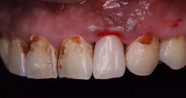 不健康牙齿,不健康牙齿颜色对照图