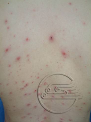 传染性软疣儿童怎么治可以断根,儿童脸上长了传染性软疣怎么办