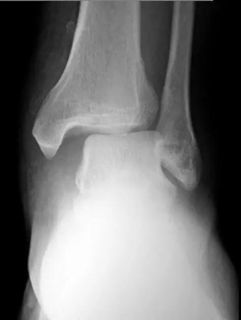 所有骨折都叫什么名字,骨折的名称有哪些